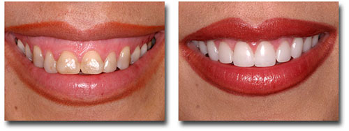 Gum Smile Treatment