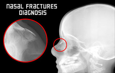 Nasal Fracture Diagnosis X-ray