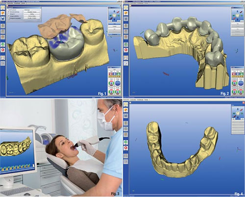 CAD-CAM technology