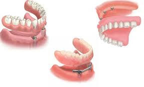 Dental prostheses