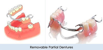 Removable tooth dentures